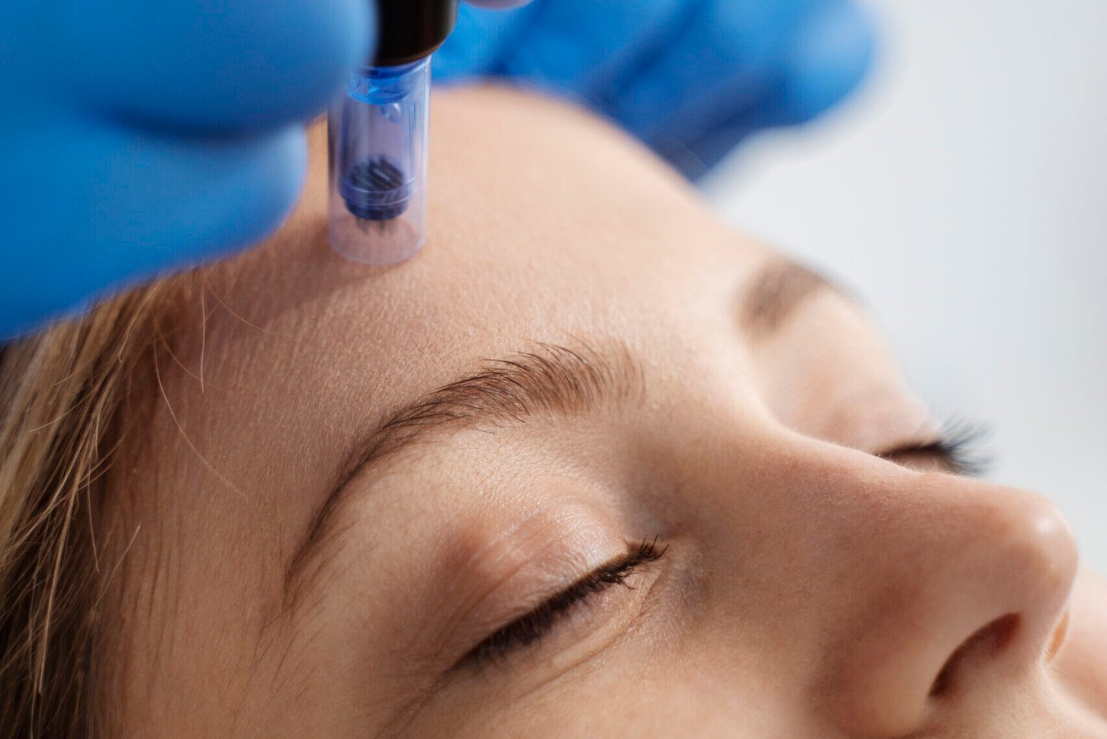 Needling